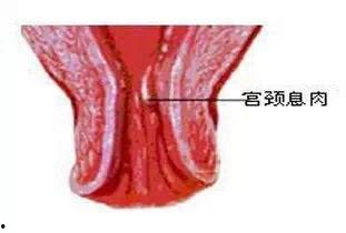 宫颈息肉可以吃茄瓜,营养食疗新选择